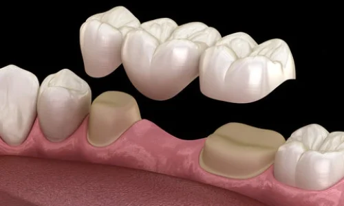 Dental Bridge
