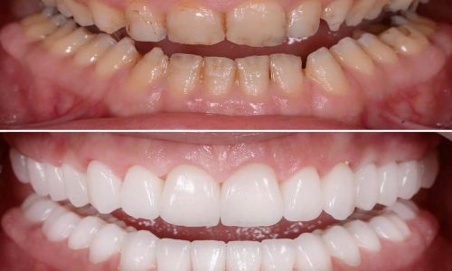 Full-Mouth-Rehablitation