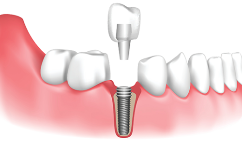 dental-implant